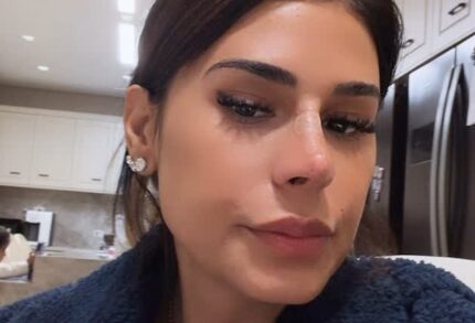 Rinoplastia? Simone Mendes explica mudança no nariz e revela procedimento realizado