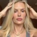 Yasmin Brunet exibe marcas do lipedema e relata dor e queimação